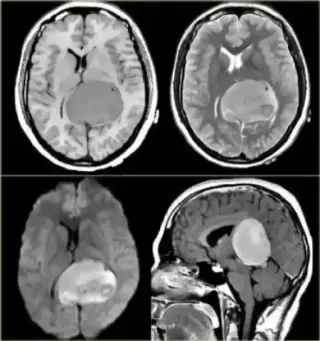 CT Scan