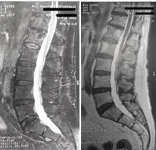 MRI